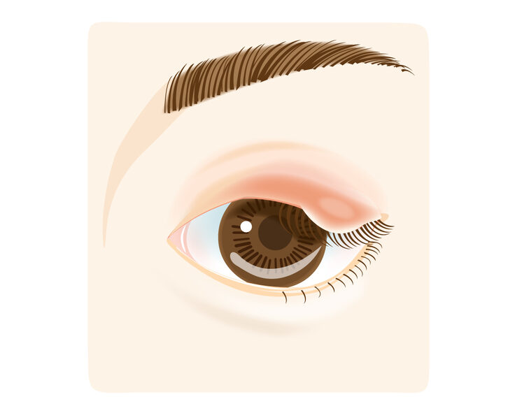 麦粒腫（ばくりゅうしゅ・ものもらい）