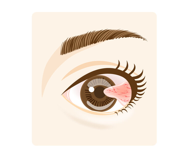 翼状片（よくじょうへん）とは