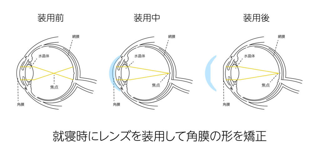 オルソケラトロジー治療