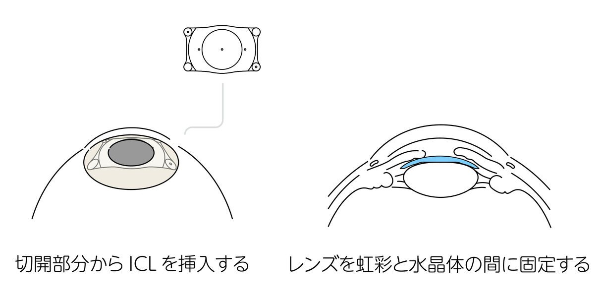 レンズの挿入と固定