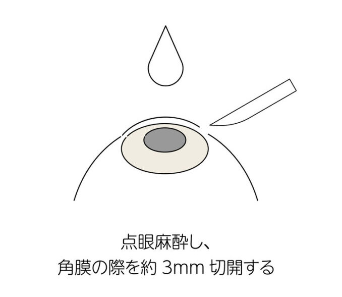 角膜を小さく切開