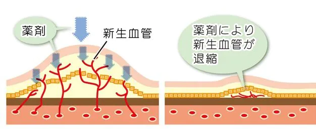 硝子体内注射（抗VEGF薬注射）とは